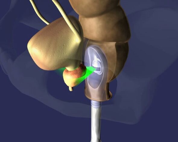l'impatto degli ultrasuoni sulla prostata con la prostatite
