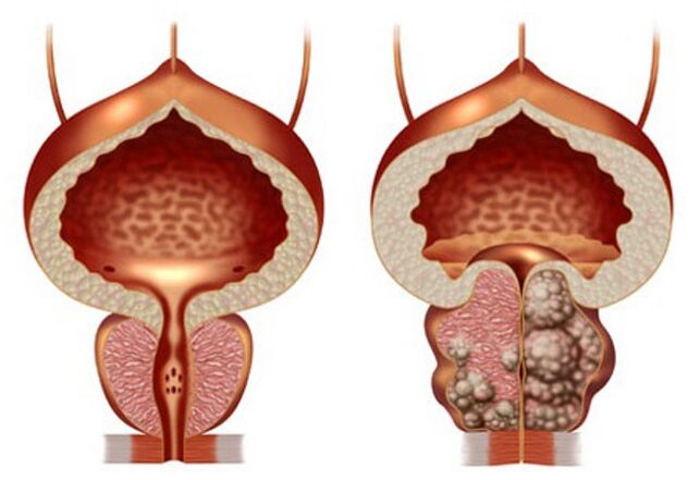 prostata sana e adenoma prostatico