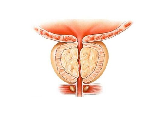 Ingrossamento della prostata con prostatite
