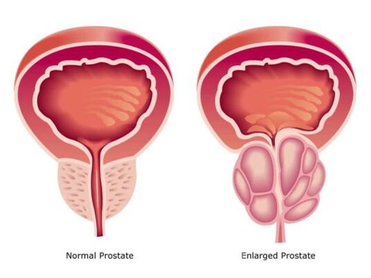 Prostata normale e ingrossata