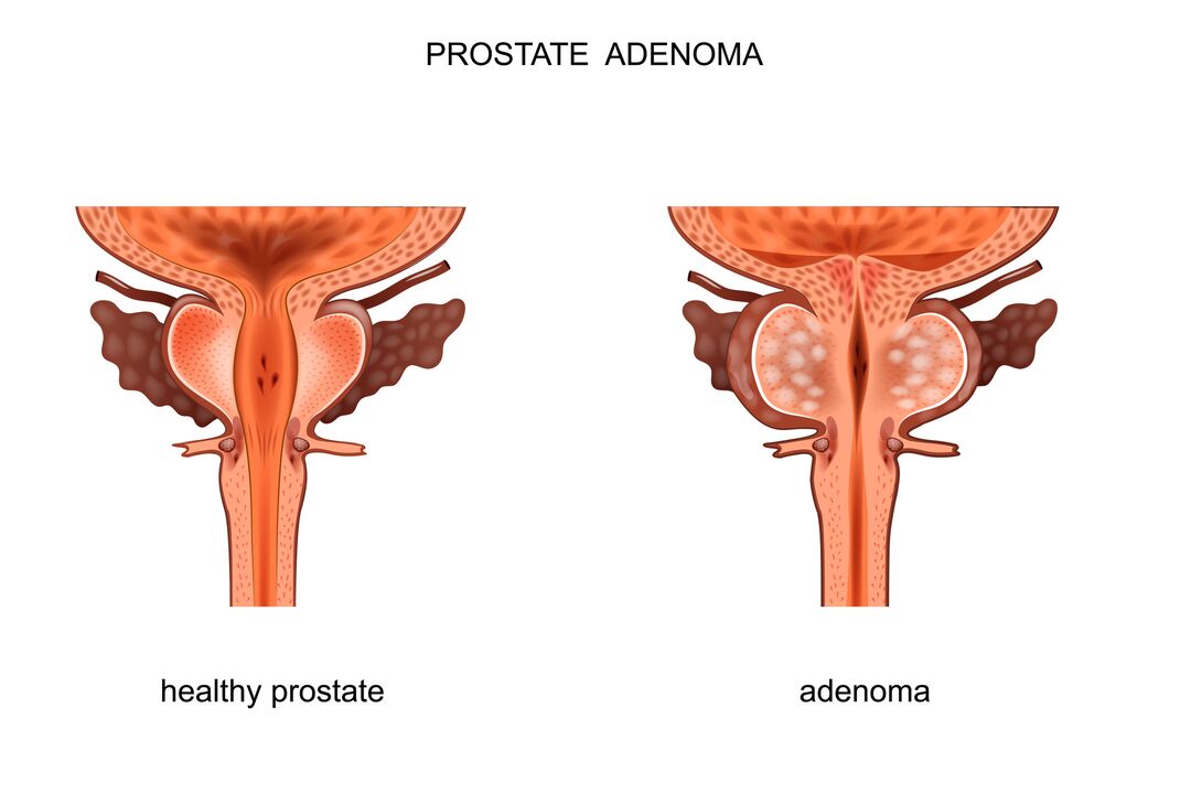 prostata sana e con adenoma